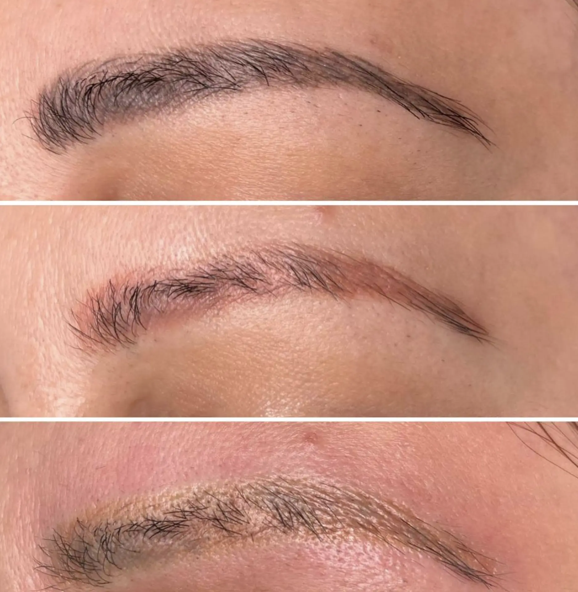 Tattoo removal consultation at Face Figurati