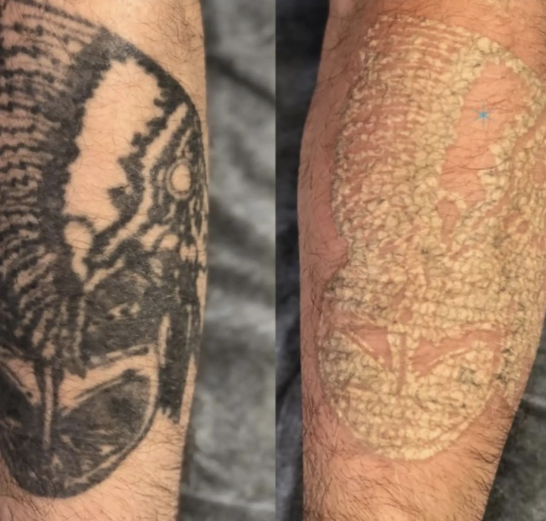 Tattoo removal consultation