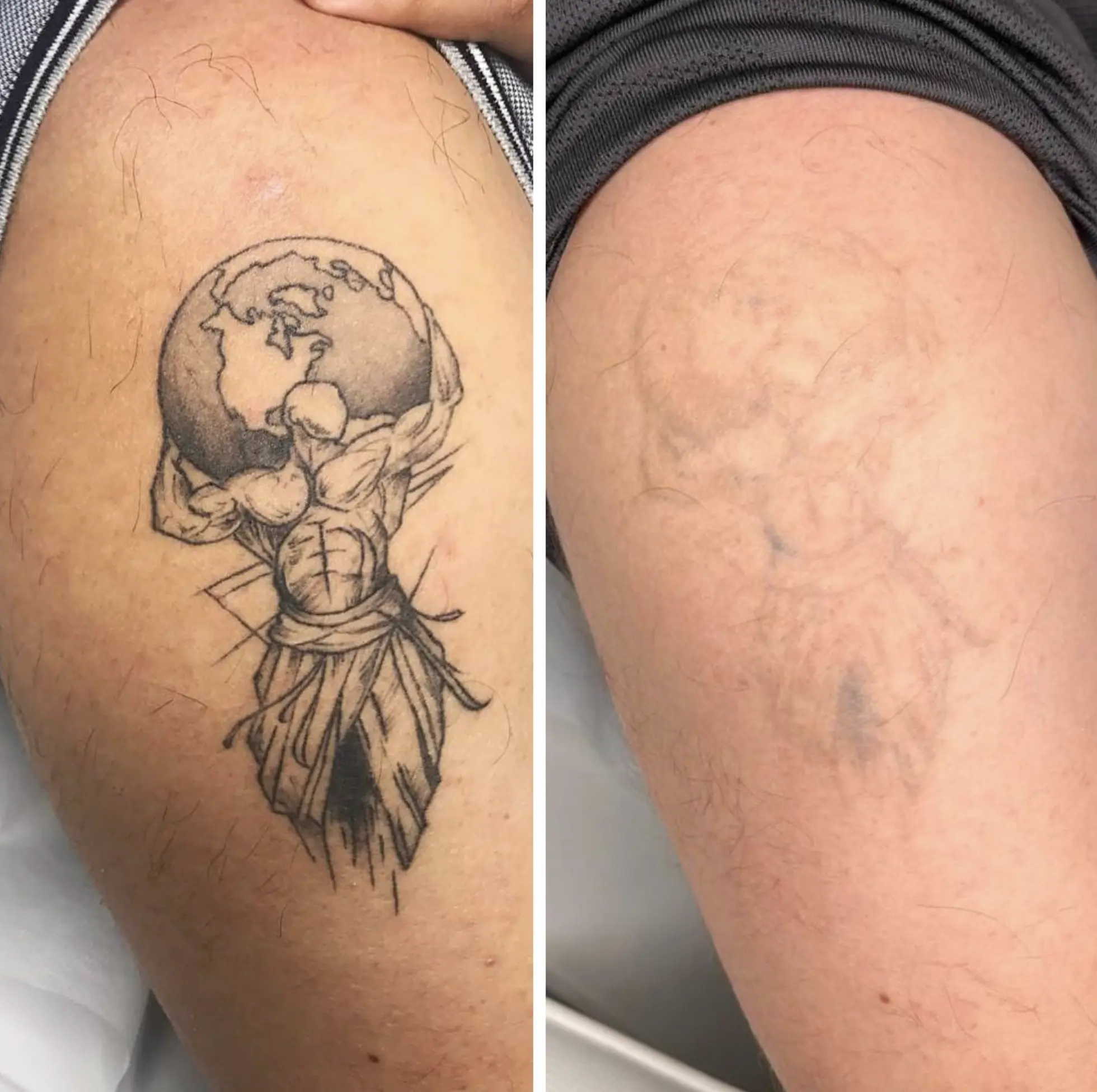 results of free tattoo removal