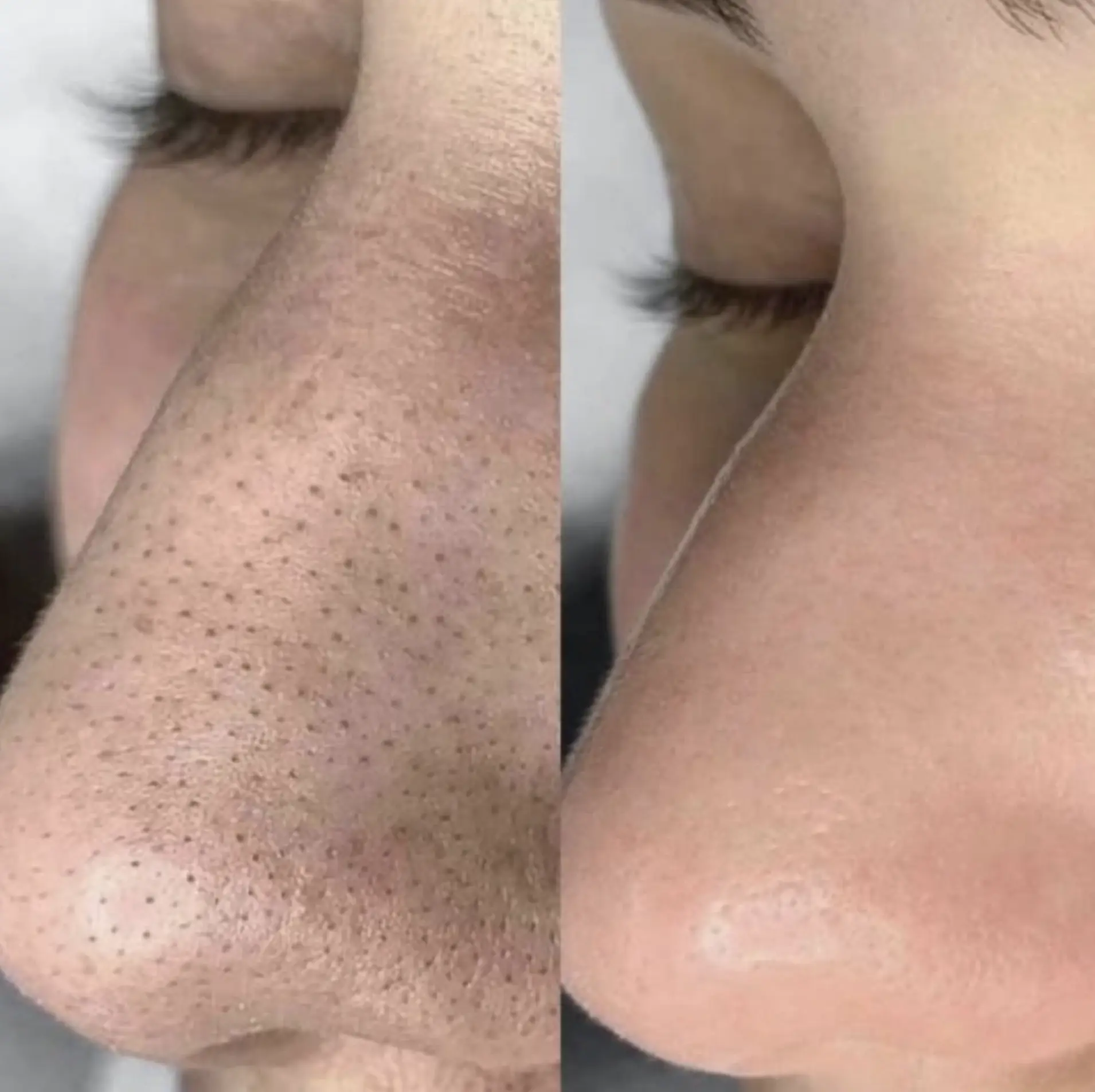 cheap hydrafacial brisbane